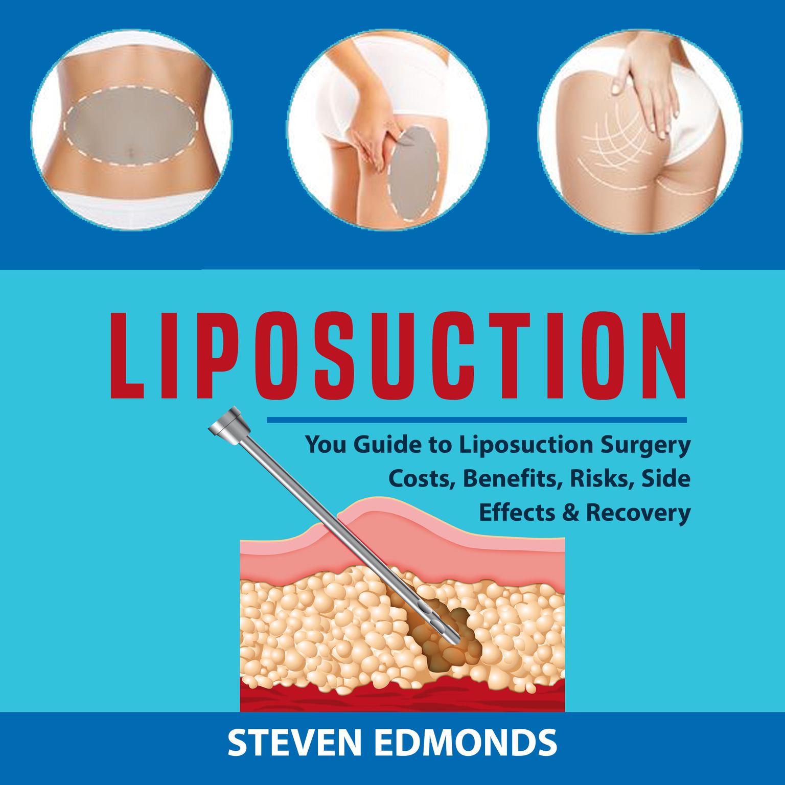 Liposuction: You Guide to Liposuction Surgery Costs, Benefits, Risks, Side Effects & Recovery Audiobook, by Steven Edmonds