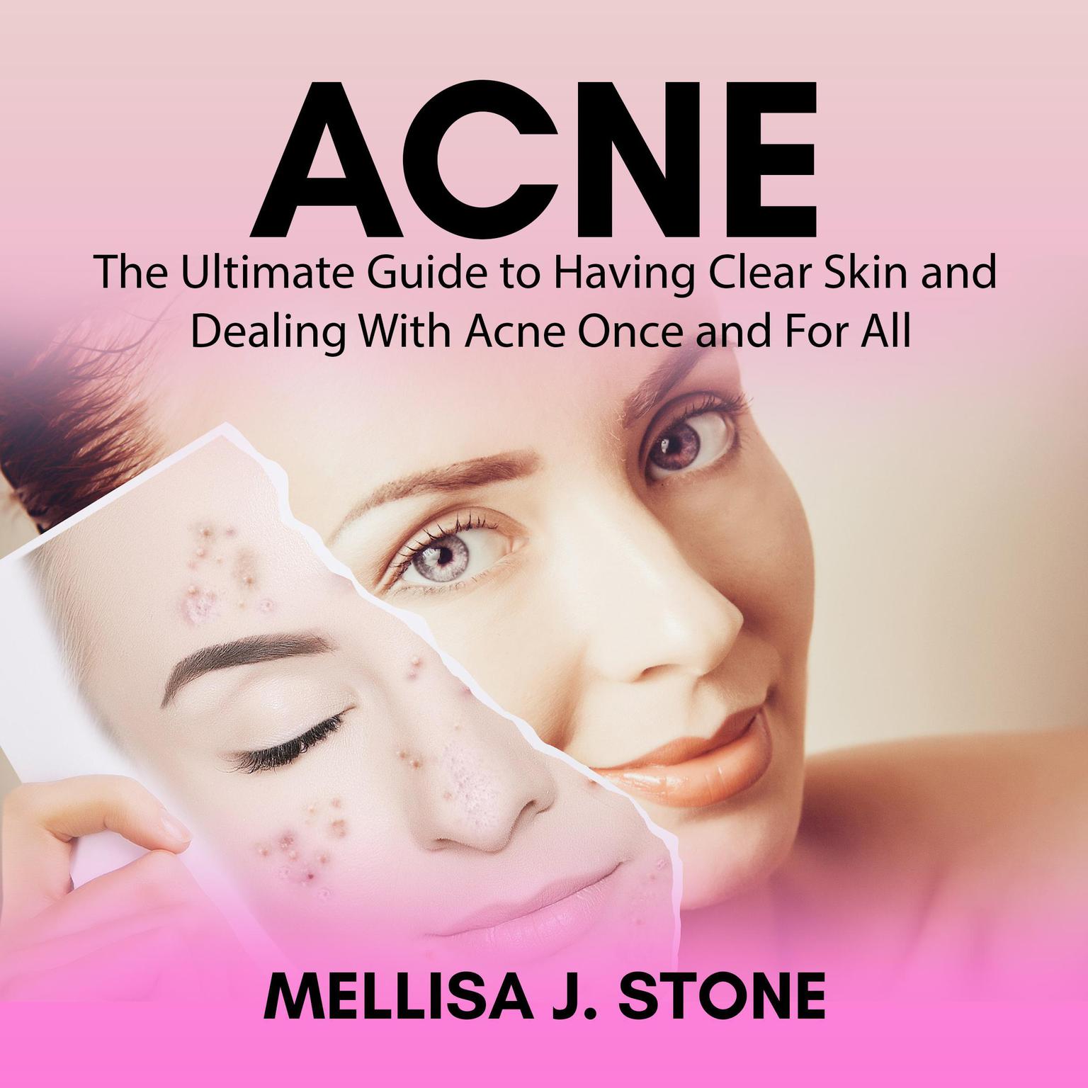 Acne: The Ultimate Guide to Having Clear Skin and Dealing With Acne Once and For All Audiobook, by Mellisa J. Stone